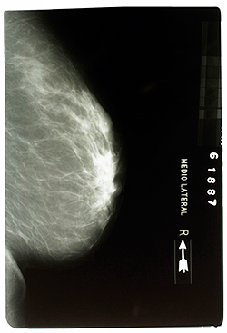 cancers dûs aux mamo